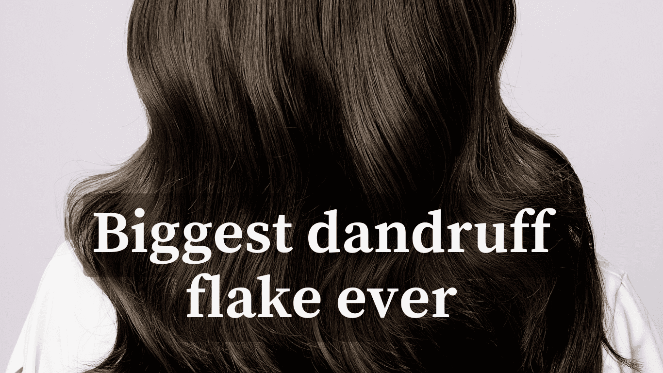 biggest dandruff flake ever