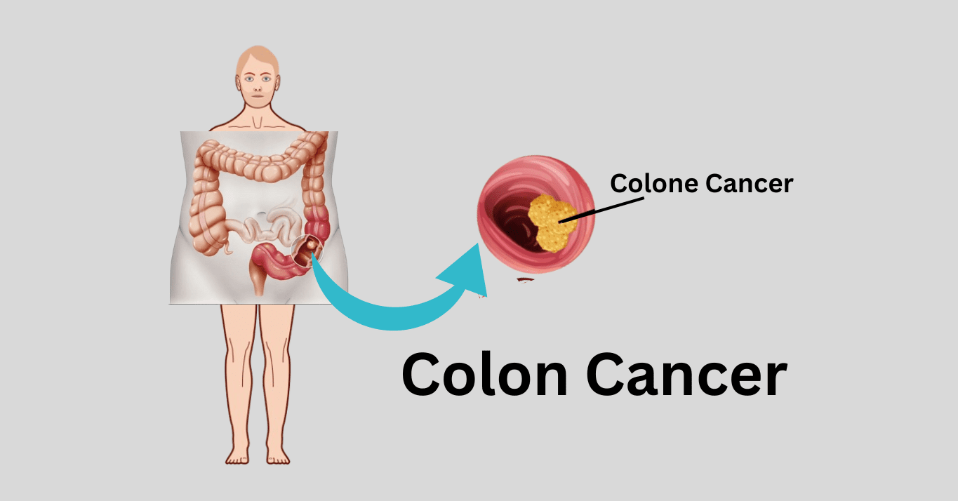 colon and rectal cancer