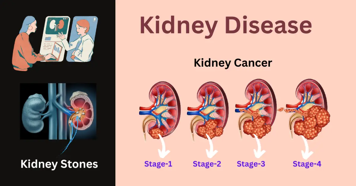 causes of kidney disease | Stones & cancer