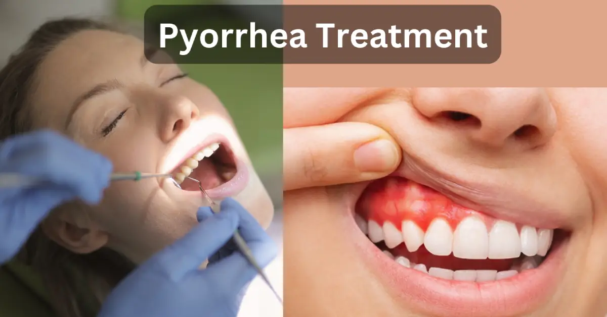 Pyorrhea Treatment