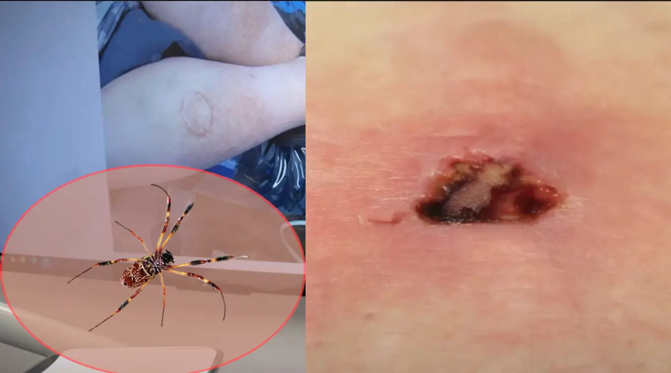 Joro Spider Bite Symptoms | Health Mozo