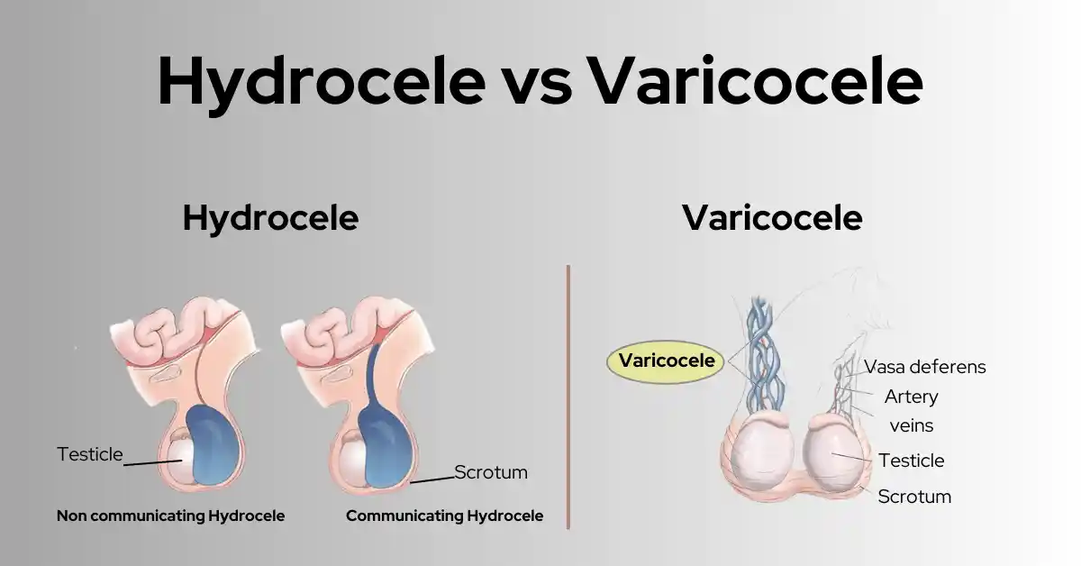 Comparison of hydrocele and varicocele, detailing causes, symptoms, and treatments.