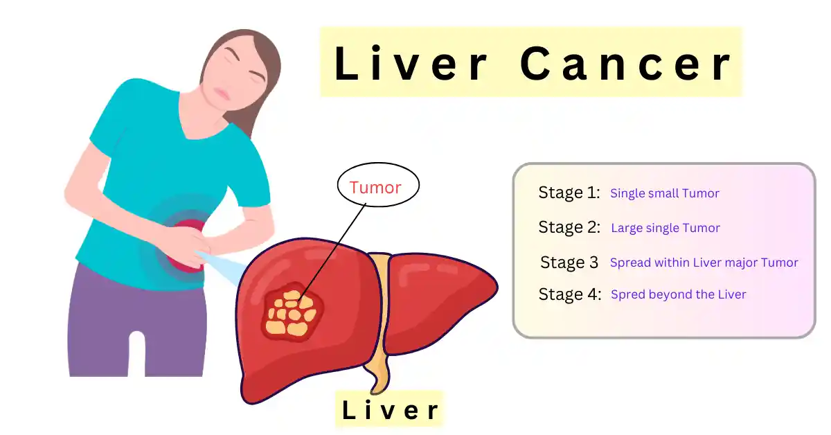 Liver Cancer and stages