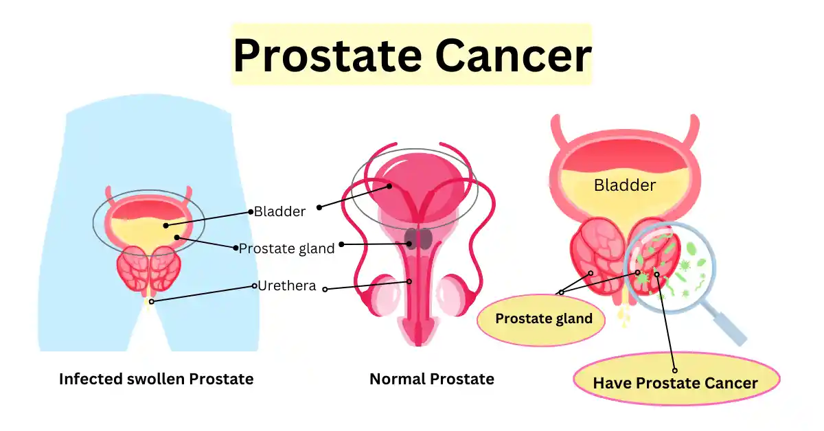 5 warning signs of prostate cancer | a diagram of prostate cancer