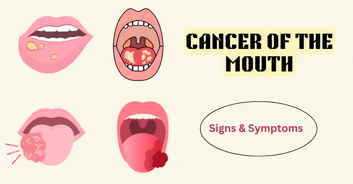 Cancer of the Mouth Signs and Symptoms