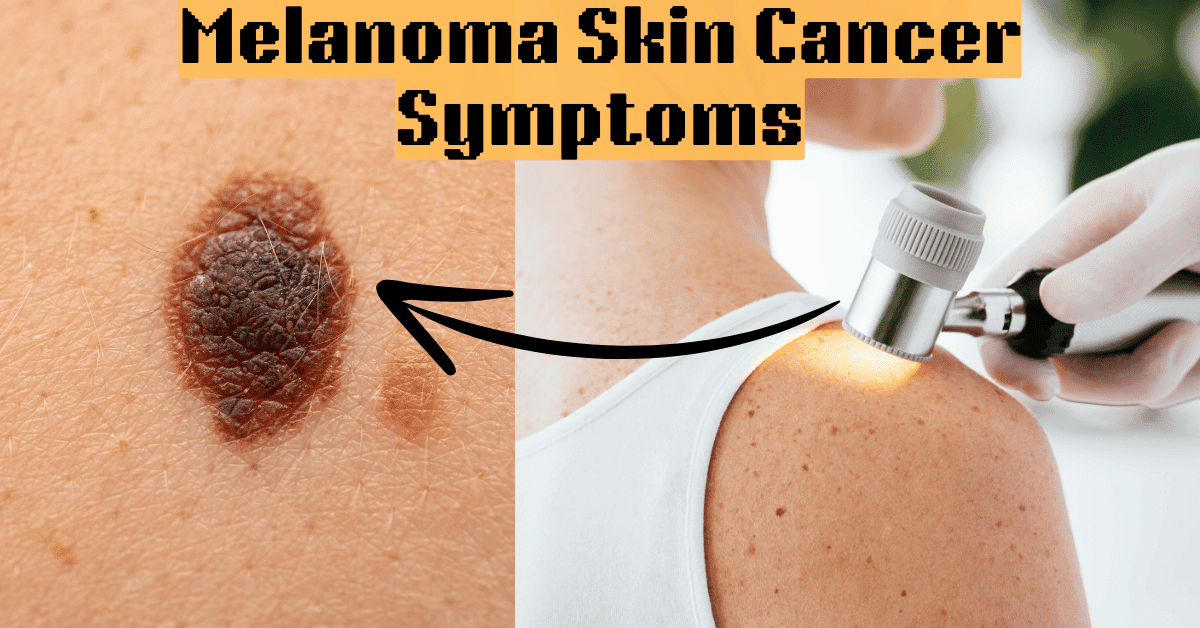 melanoma skin cancer symptoms | melanoma picture