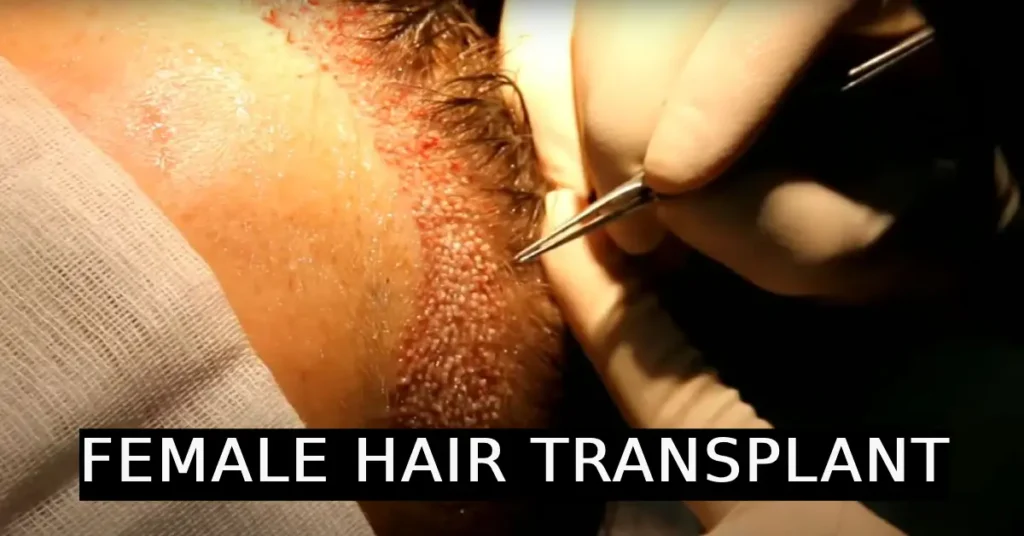 female hair transplant |frontal female hair transplant