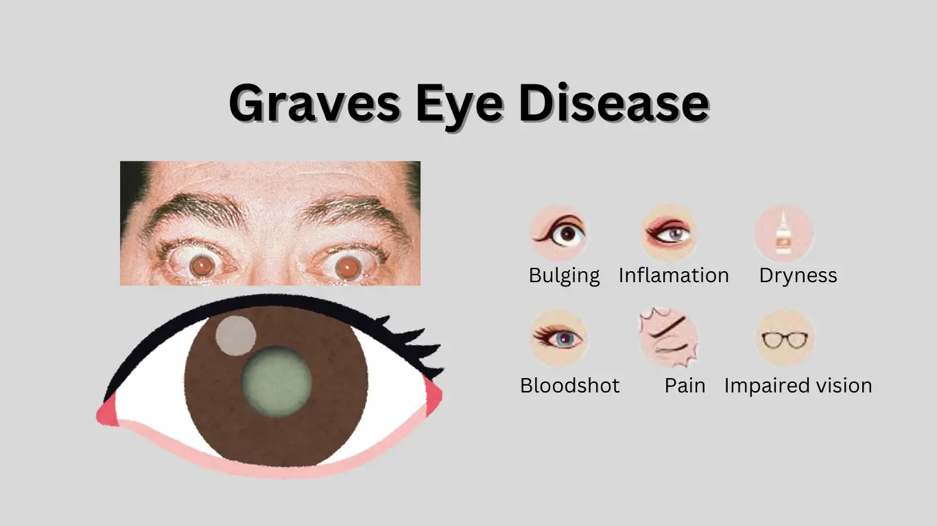 Graves Disease Eye Health Treatment Options 2026