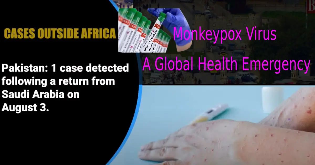 Monkeypox Virus: A Global Health