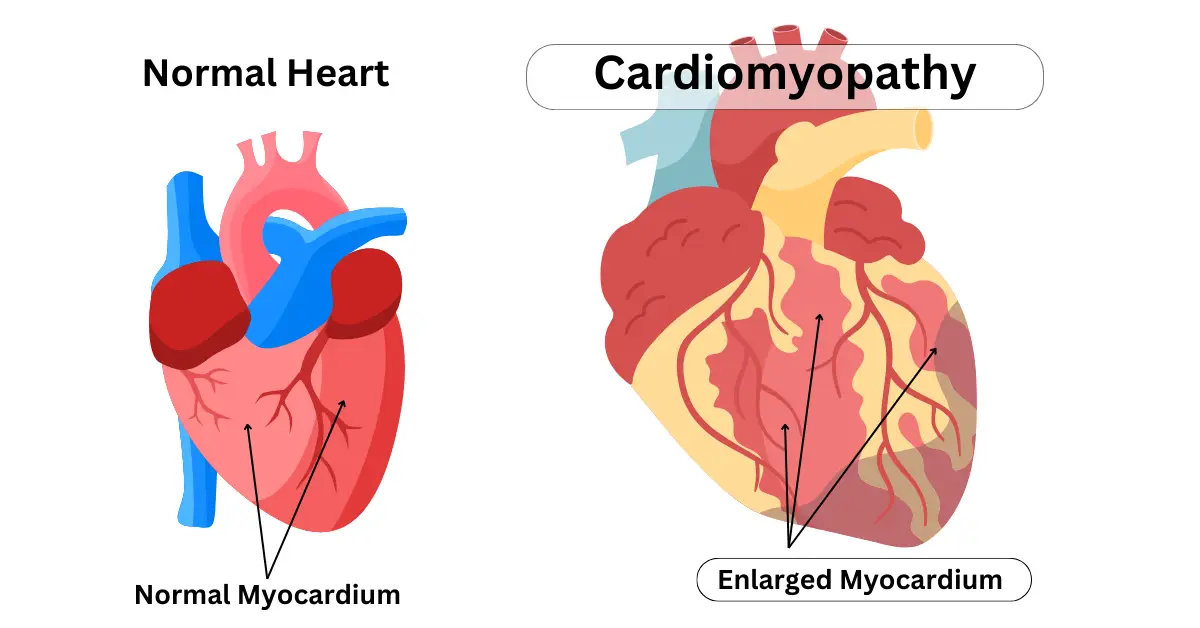 Various treatment options for cardiomyopathy including medication, lifestyle changes, and surgery