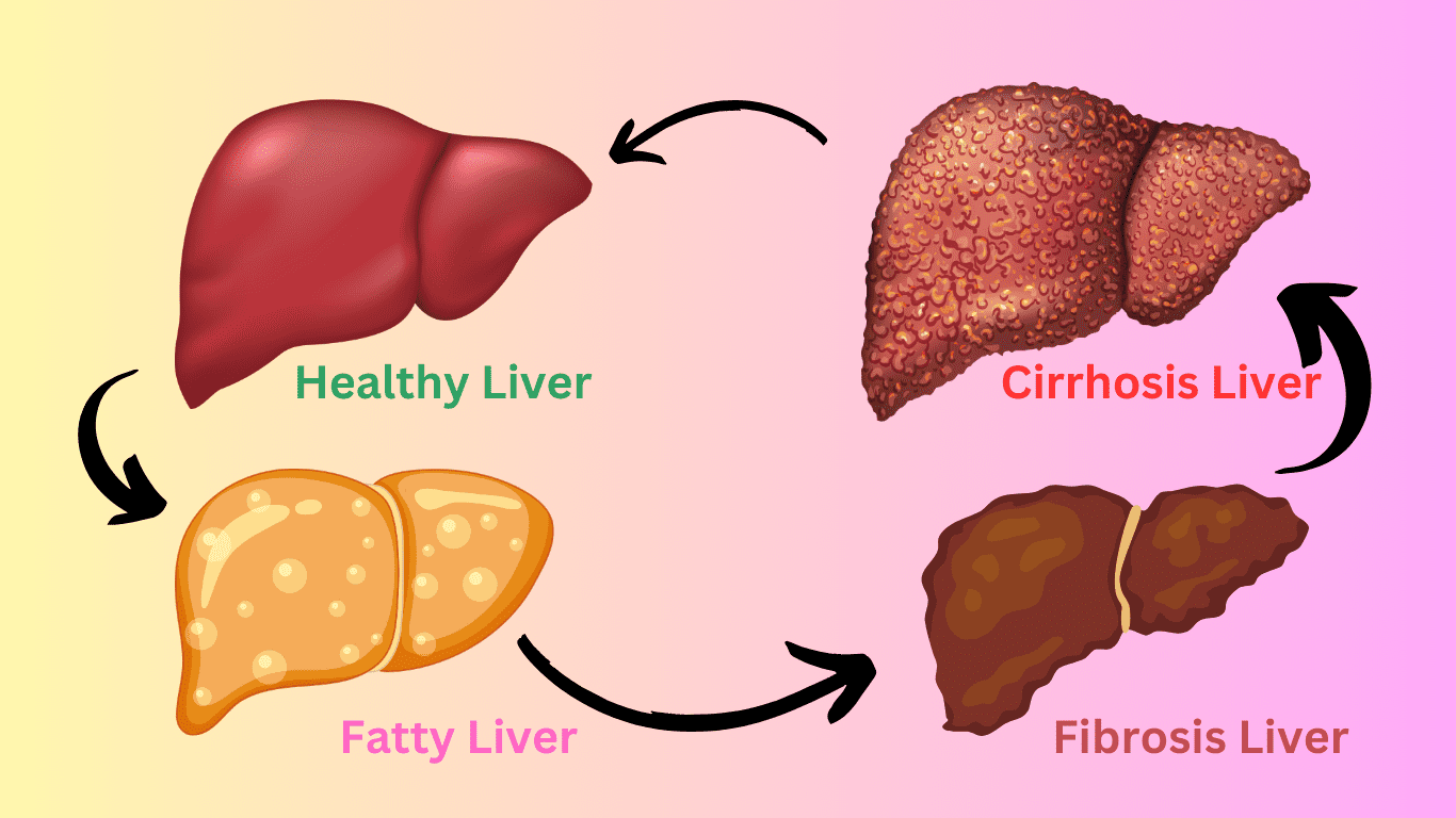 Diagram illustrating cirrhosis of the liver, highlighting stages toward Liver cirrhosis