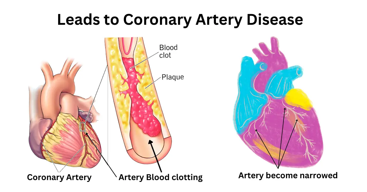 Coronary Artery Disease: illustration showing narrowed arteries and reduced blood flow to the heart.