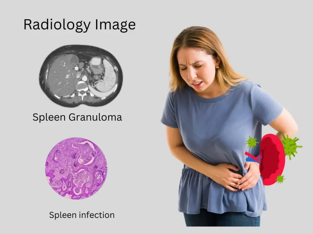 Radiology image showing the formation of granulomas in the spleen.