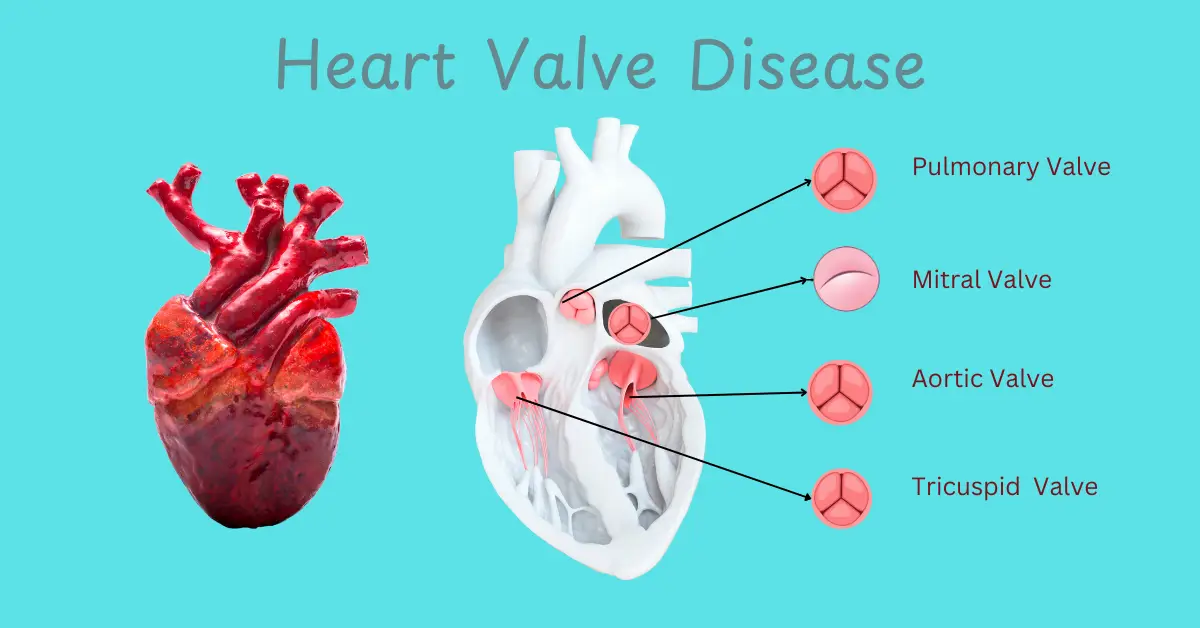 Illustration of heart valve disease showing heart valve