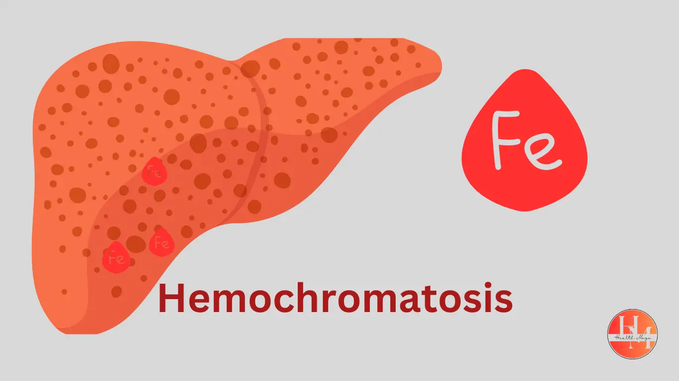 Hemochromatosis and Liver Disease – Iron Overload Impacting the Liver