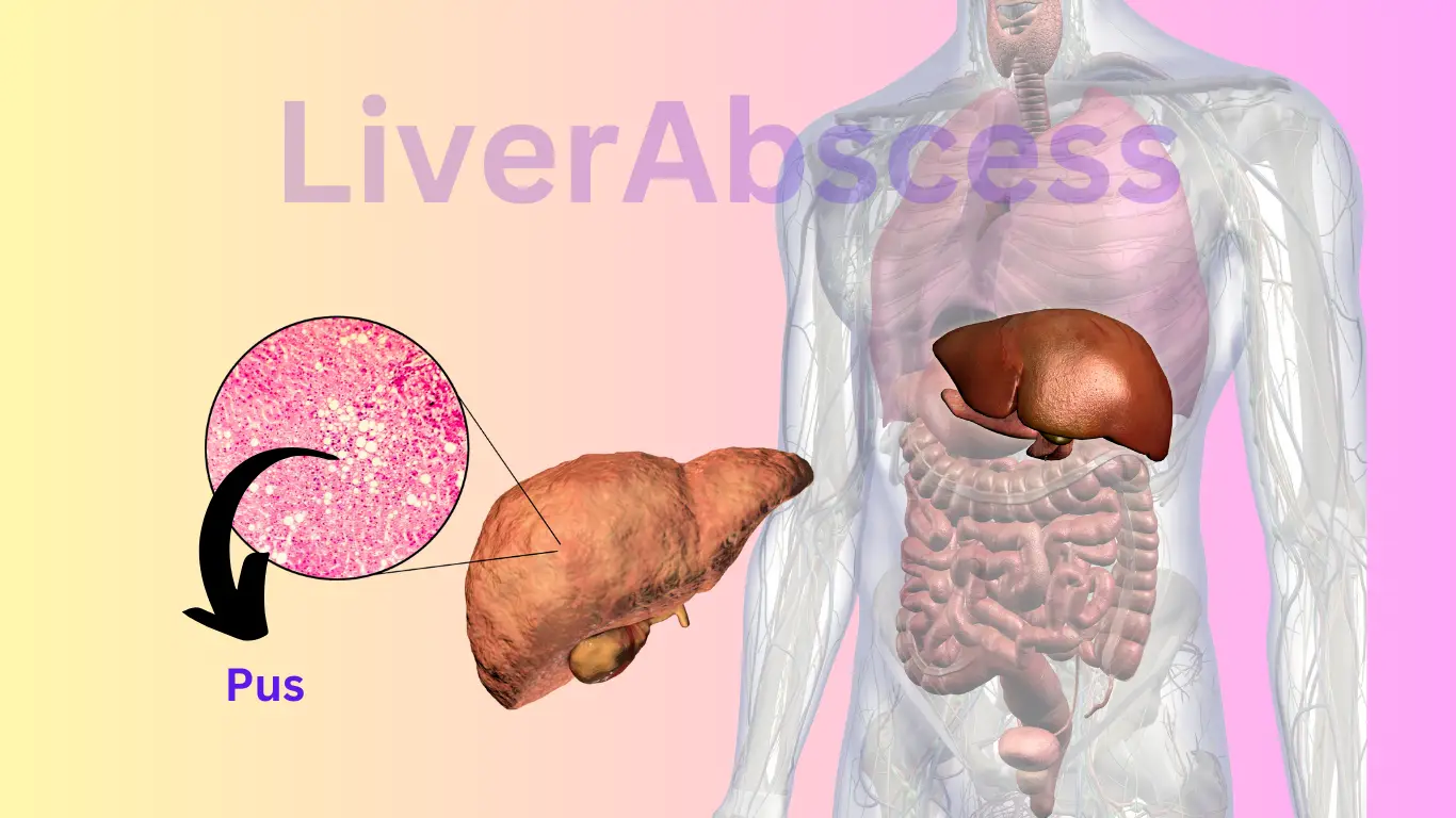 Liver abscess illustration showing infection in the liver