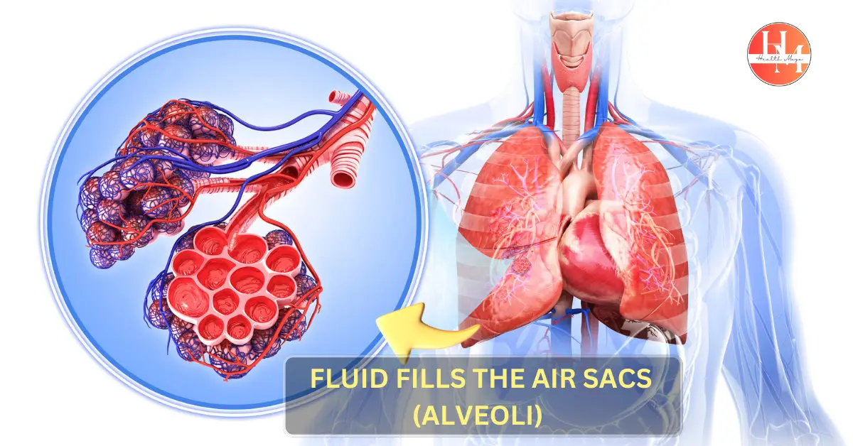 Illustration of pulmonary edema showing fluid accumulation in the lungs' alveoli.