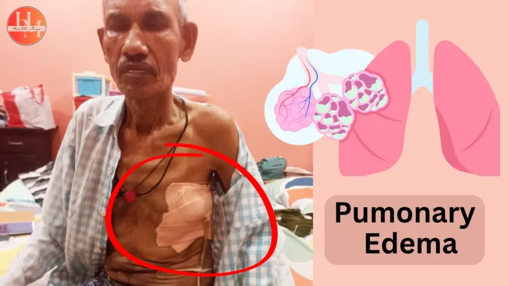 Pulmonary edema patient receiving medical treatment.