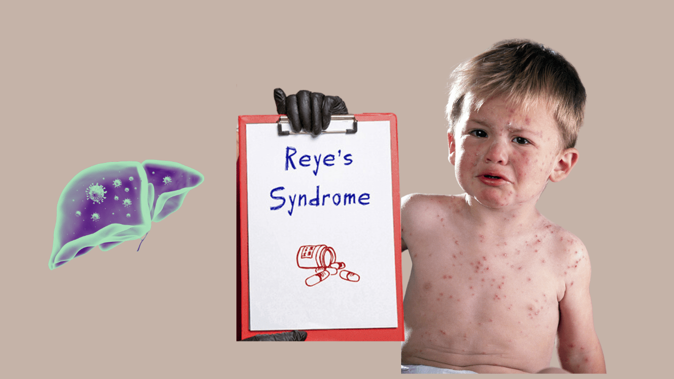 Reye's Syndrome affecting liver and brain in children