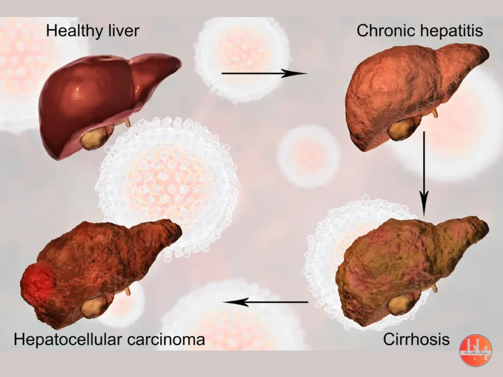 Hepatocellular carcinoma (HCC) diagram showing liver cancer development