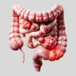 Visual representation of a stomach ulcer or peptic ulcer